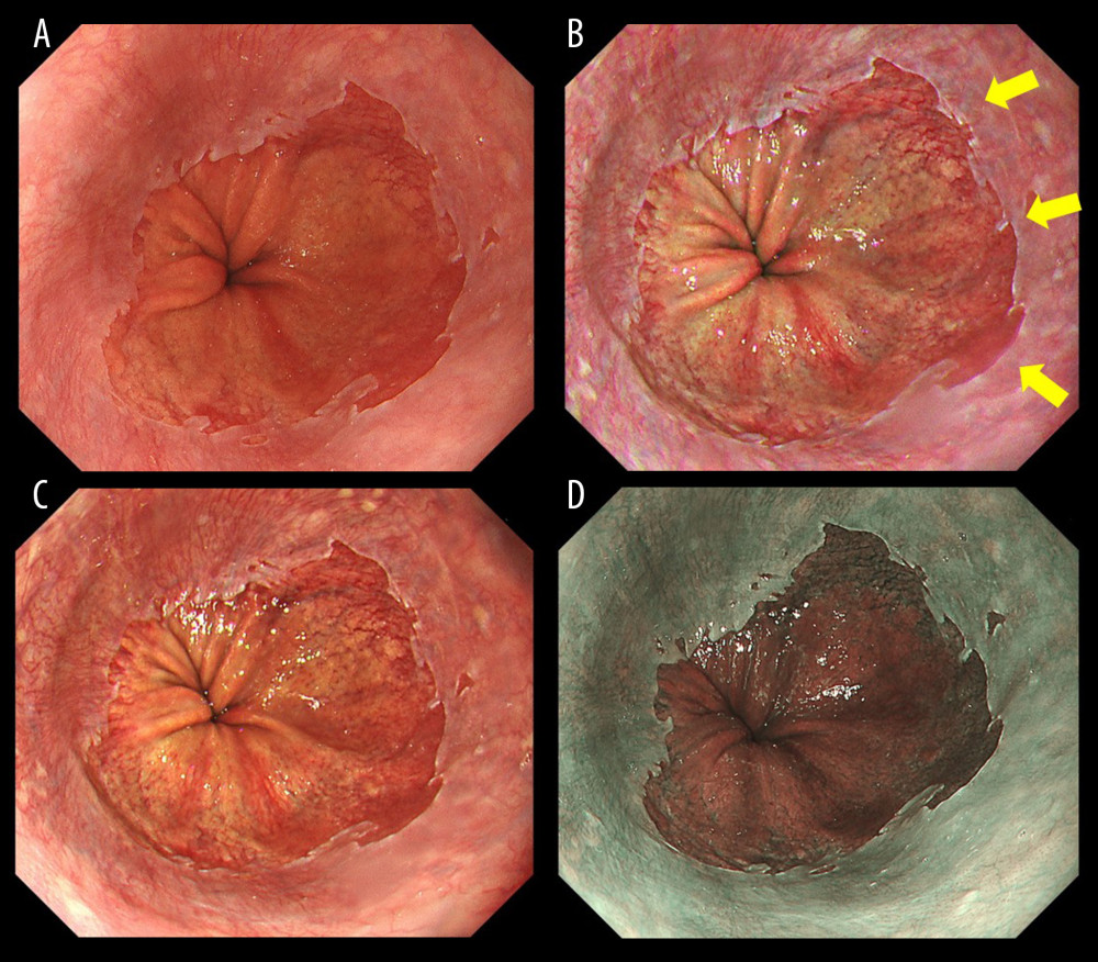 Endoscopic images of a representative case in which the gastroesophageal junction was detected based on the visibility of palisade vessels. (A) White light imaging (WLI). Barrett’s mucosa existed non-circumferentially in the lower esophagus and extended upwards for approximately 1 cm; this was diagnosed as short-segment Barrett’s esophagus (SSBE, Prague Classification: C0M1). (B) Texture and color enhancement imaging mode 1 (TXI-1). Yellow arrows indicate SSBE, which is emphasized in a red color, and palisade vessels. The gastroesophageal junction (GE-J) was easily detected by the distal end of lower esophageal palisade vessels. (C) Texture and color enhancement imaging mode 2 (TXI-2). SSBE is emphasized with TXI-2. (D) Narrow-band imaging (NBI). The visibility of palisade vessels was decreased.