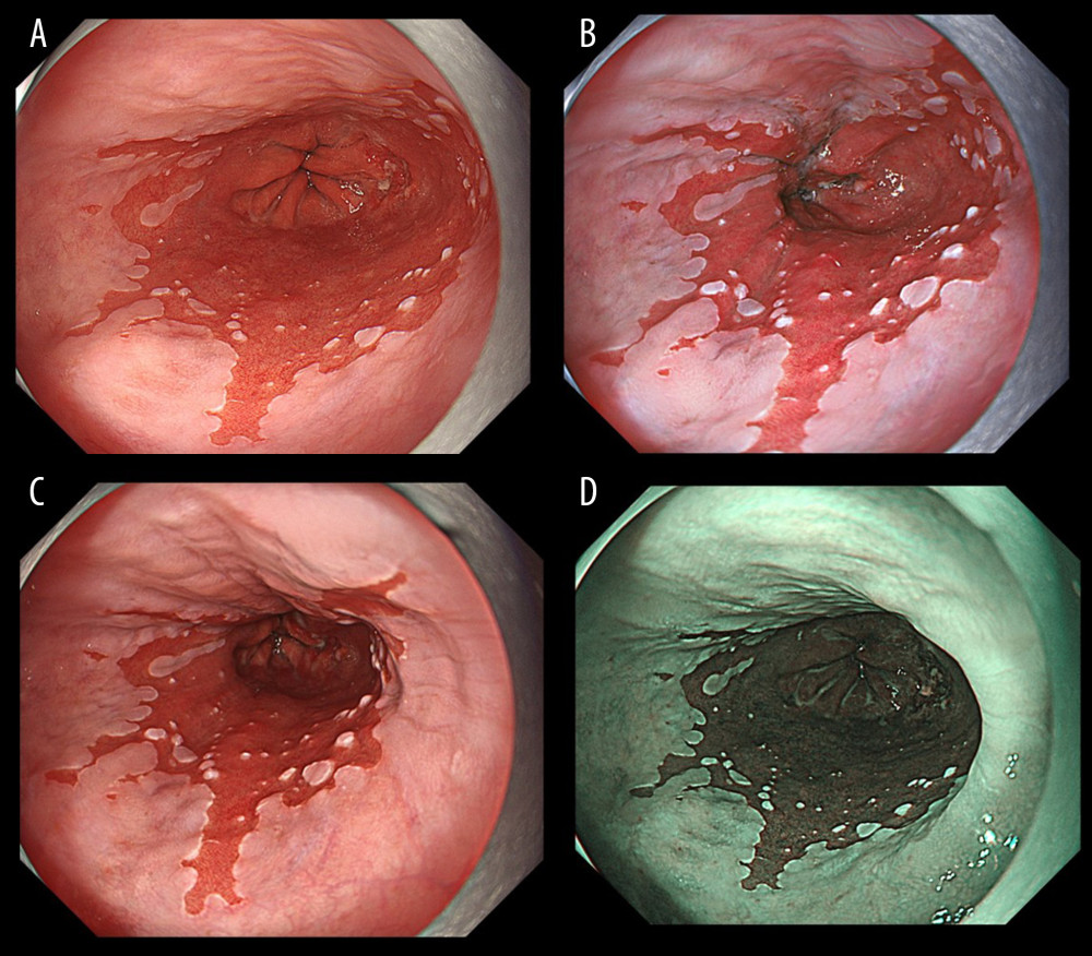 Endoscopic images of a representative case in which the gastroesophageal junction was detected due to the visibility of the proximal end of the gastric folds. (A) White light imaging (WLI). Barrett’s mucosa existed approximately 1 cm circumferentially and 3 cm in maximum length in the lower esophagus; this was diagnosed as short-segment Barrett’s esophagus (SSBE, Prague Classification: C1M3). In this case, the palisade vessels were invisible and the gastroesophageal junction (GE-J) was detected by the proximal end of the gastric folds. (B) Texture and color enhancement imaging mode 1 (TXI-1). (C) Texture and color enhancement imaging mode 2 (TXI-2). (D) Narrow-band imaging (NBI).