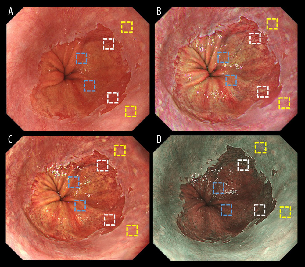 Representative endoscopic images using (A) white light imaging (WLI), (B) texture and color enhancement imaging mode 1 (TXI-1), (C) texture and color enhancement imaging mode 2 (TXI-2), and (D) narrow-band imaging (NBI) with the region of interest (ROI, 40×40 pixels). ROIs were set in the esophageal mucosa (yellow box), Barrett’s esophagus (white box), and gastric mucosa (blue box), and the same positions in all 3 images of a particular lesion were selected.