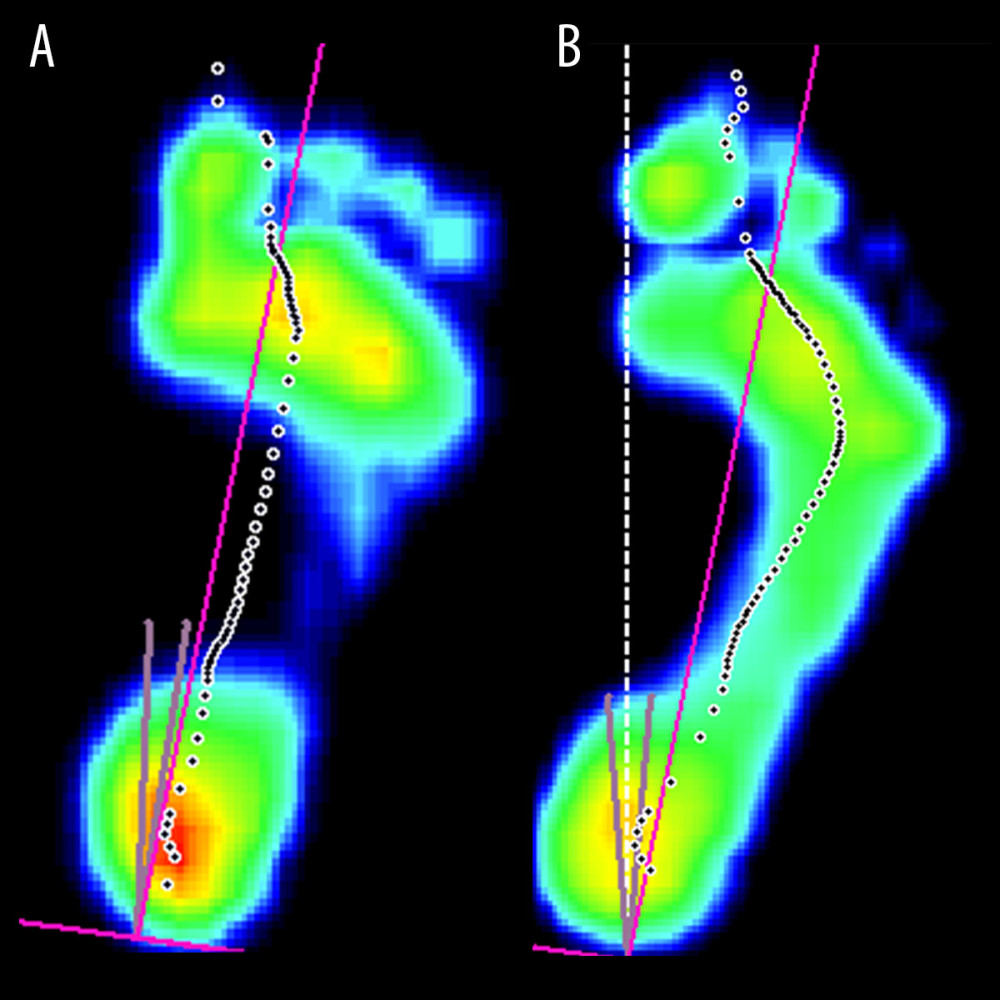 Schematic diagram of plantar pressure distribution between normal (A) and CAI patients (B) during walking(A) Normal individual; (B) CAI patient. The purple line stands for longitudinal axis of the foot, passing through the midpoint of heel and the midpoint of the 2nd and 3rd metatarsal heads. The dashed line composed of black dots represents the COP trajectory. The figure shows that the COP trajectory of CAI patients is shifted to the lateral side of the foot compared to normal individuals. Scientific Footscan® software (RSscan International®, Belgium) was used for creation of the figure.