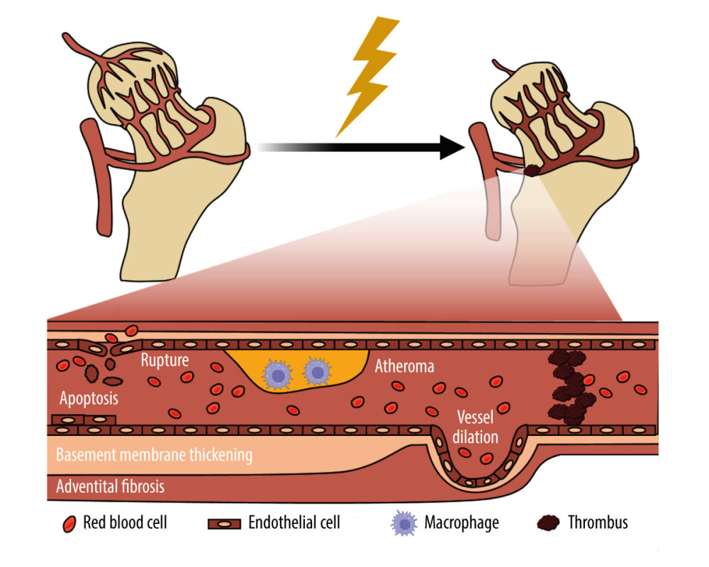 Schematic of the damage of radiation on blood vessel. Radiation-induced vascular injury begins with progressive endothelial loss, and followed and partially overlapped by thrombus, wall rapture, and hemorrhage. Long term morphologic changes include endothelial proliferation, basement membrane thickening, adventitial fibrosis, vessel dilatation, and atheroma, which is rich of macrophages. Created with BioRender.com.