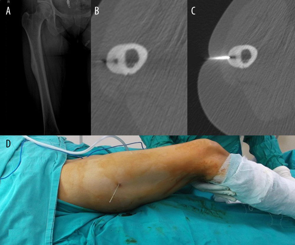 (A–D) 27-year-old male patient. The nidus in the femur was marked with a guide wire with the help of tomography.
