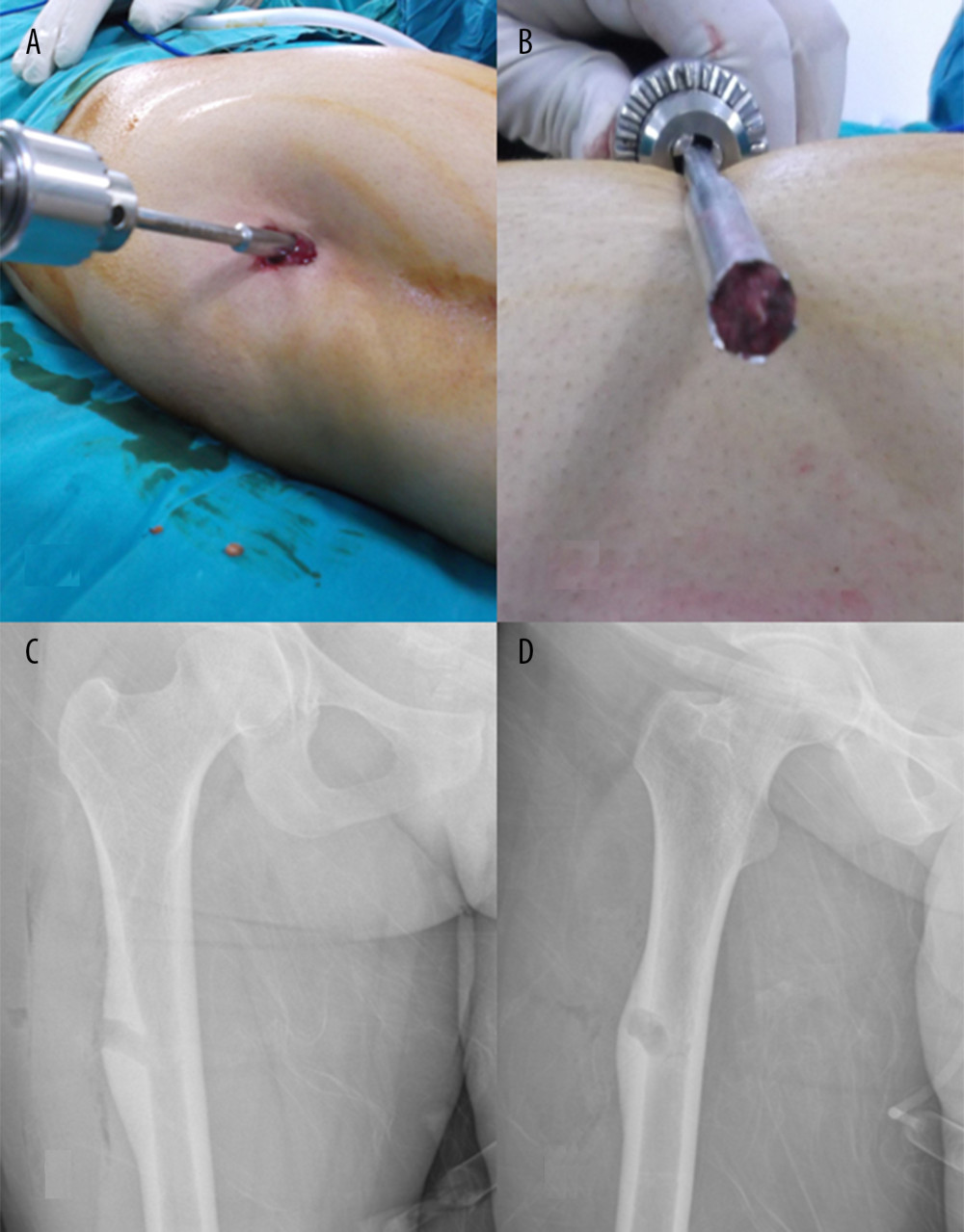 (A–D) After the nidus was marked with guidewire, it was removed with a trephine. Post-procedure radiographs show that the nidus has been excised.