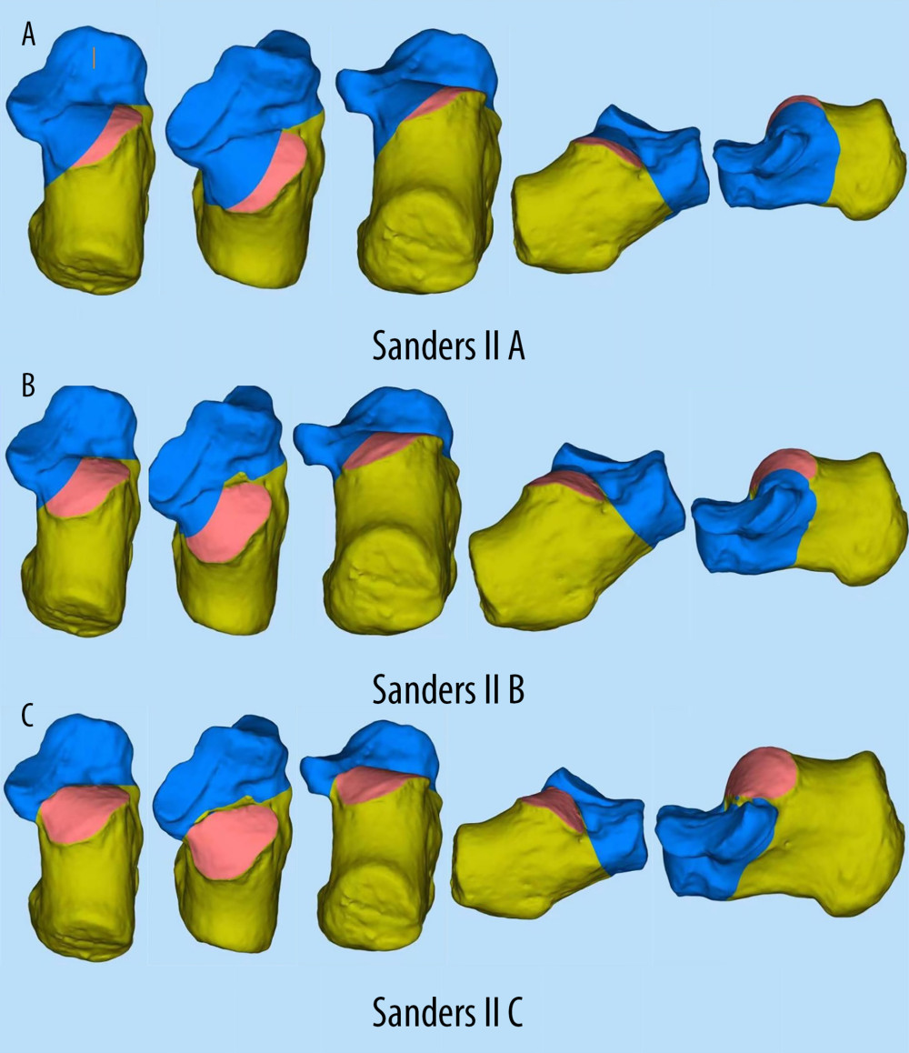 (A–C)3D model of Sanders type II calcaneal fracture.