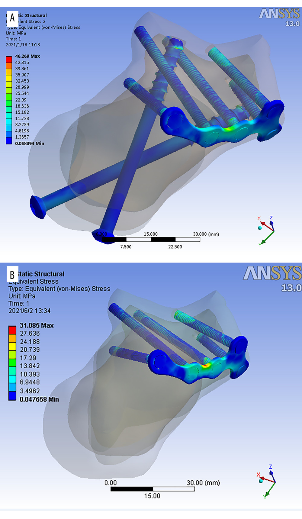 (A, B) 3D model of minimally invasive internal fixation system for Sanders type II calcaneal fracture. (A – simple minimally invasive plate. B – minimally invasive plate with long screws from posterior to anterior).