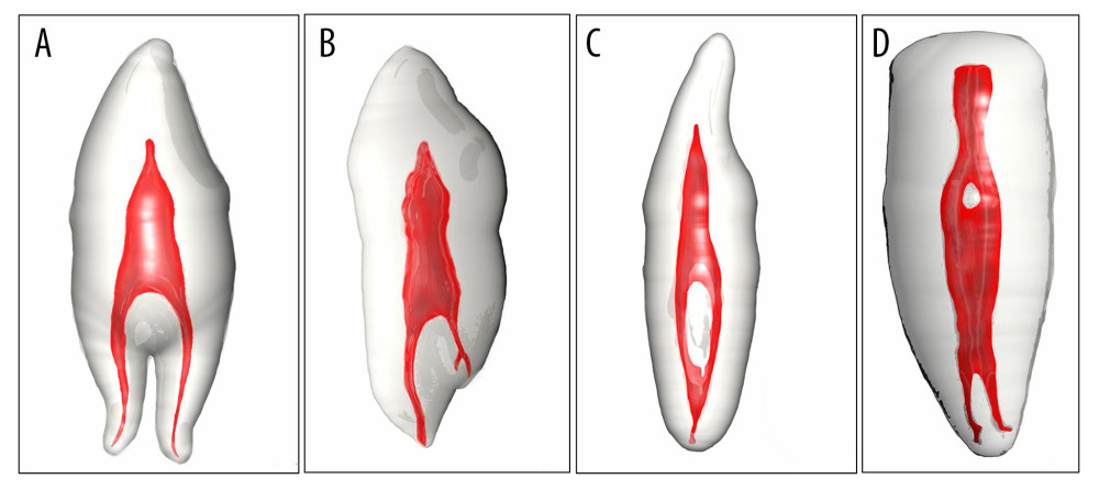 Some shapes of root morphology and canal configuration of canine. A–D according to Ahmad’s classification are [(2) 43B (1) L(1)], [(1)43(1-2)], [(1)32(1-2-1)], and [(1)31(1-2-1-2)], respectively. A–D according to Virtucci’s classification are type I, V, III, VI, respectively.