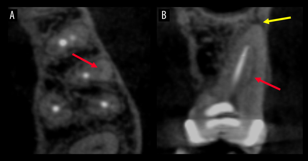 Cone-beam computed tomography images demonstrating a missed canal and a periapical lesion. The axial plane (A) and the coronal plane (B) of a maxillary first molar with an untreated mesiobuccal canal (indicated by red arrow) and periapical lesion (indicated by yellow arrow). OnDemand3D Dental software (Cybermed, Seoul, Korea) and Adobe Photoshop version 23.4.1 software (Adobe Inc., San Jose, CA, USA) were used to create this figure.