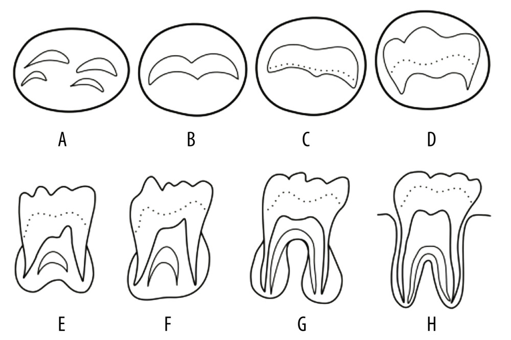 Tooth mineralization stages according to Demirjian et al. (1973). Stage A: Calcification of the occlusal surface occurs without fusion; Stage B: Formation of occlusal surface by fusion of the mineralization points; Stage C: Enamel is formed and the formation of dentin has started, with no pulp horns in the pulp chamber; Stage D: Crown is formed up to the cement–enamel junction, with commencement of root formation; Stage E: The roots are shorter than the crown height and the radicular bifurcation is calcified; Stage F: The roots are equal or longer than the crown height; Stage G: The walls of the root canal are parallel, with the apical ends open; Stage H: The apexes of the roots are closed.