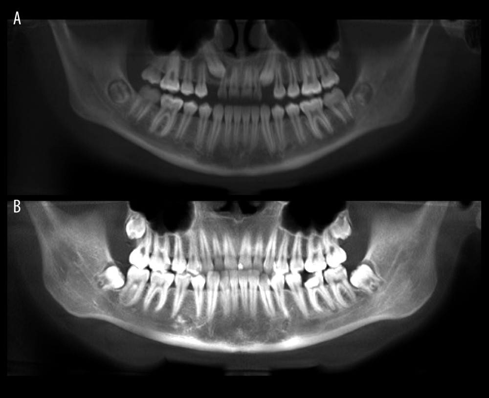 Panoramic images for assessment of the third-molar mineralization: stage C (A) and stage F (B).