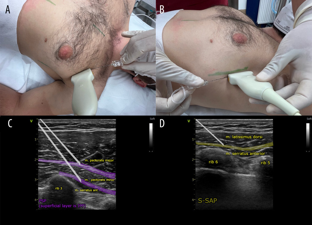 (A, C) Ultrasound transducer positioning and direction of the needle during the pectoserratus plane block (PSP) and (B, D) superficial serratus anterior plane block (S-SAP).