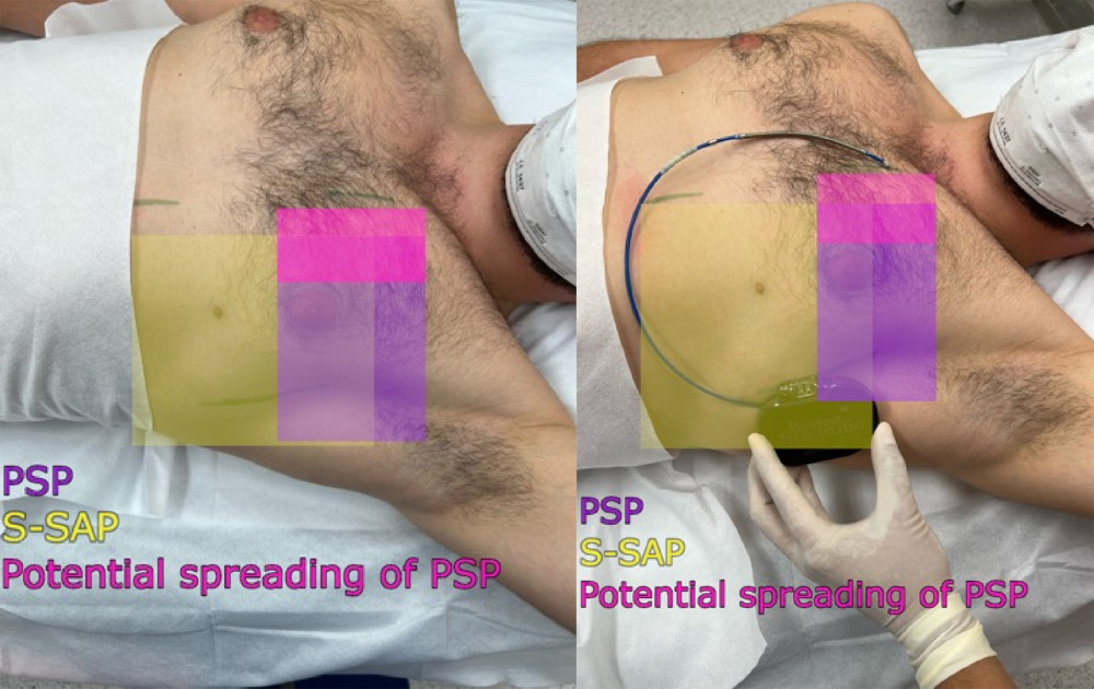 Area covered by the pectoserratus plane block (PSP) and superficial serratus anterior plane block (S-SAP): green lines indicate skin incision lines during subcutaneous cardioverter-defibrillator implantation.