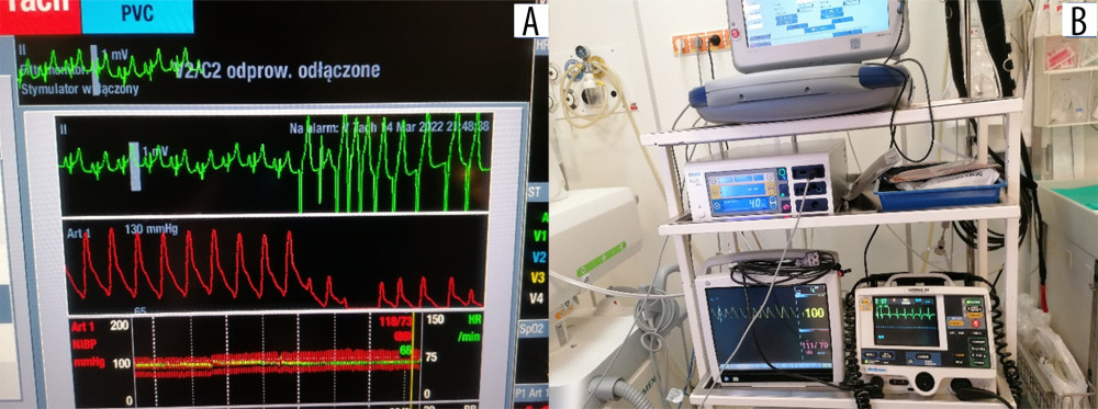 (A, B) Intraoperative electrocardiogram findings.
