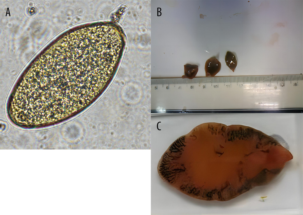 (A) Fasciola eggs (153×80 μm [× 400]) were detected in stool samples of patients with human fascioliasis; (B, C) Adult Fasciola were detected in bile ducts of patients with human fascioliasis (macroscopic view).
