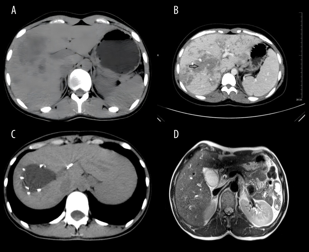 (A) Abdominal computed tomography (CT) scan showing multiple low-density shadows under the liver capsule. (B) Abdominal CT and enhanced CT showing clustered and/or tunnel-like lesions under the liver capsule, without significant enhancement (arrowhead). (C) Upper-abdominal CT and enhanced CT showing large cystic lesions in the liver parenchyma with smooth edges, and multiple punctate calcifications scattered around. (D) Adult Fasciola in the dilated common bile duct in T2 axial of magnetic resonance imaging.