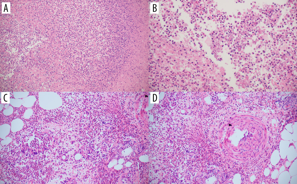 (A) Pathological results of liver biopsy results showing massive eosinophil infiltration and abscesses (hematoxylin and eosin [H&E] stain, ×100 magnification). (B) Pathological results of liver biopsy results showing eosinophilic infiltration and abscesses characterized by irregular tunnel formation (H&E stain, ×200 magnification). (C) Skin biopsy of lower limbs showing intimal proliferation and thickening of small vascular (H&E stain, ×200 magnification). (D) Skin biopsy of lower limbs showing eosinophil infiltration in the interlobular septum of subcutaneous fat (H&E stain, ×200 magnification).