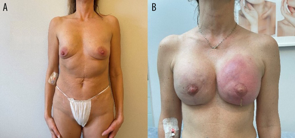 Images showing an example of (A) breast deformation and (B) breast inflammation.