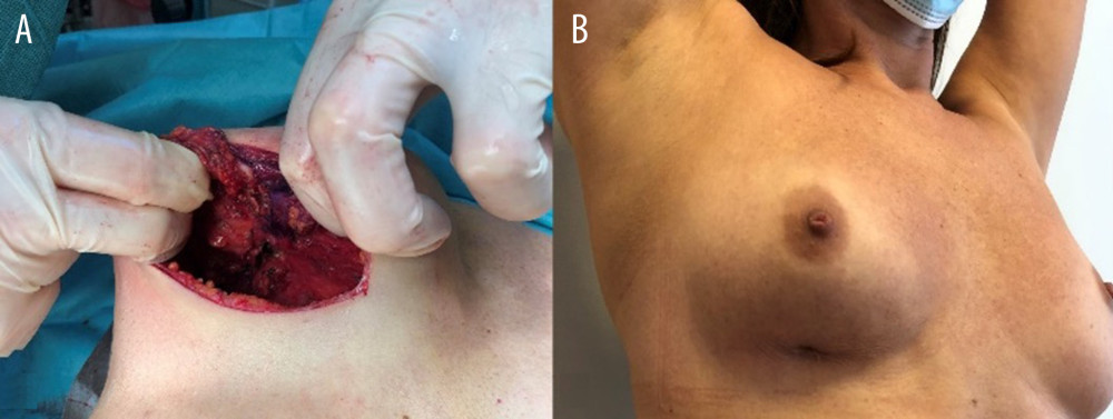 Images showing breast fistula (A) during and (B) before surgery.