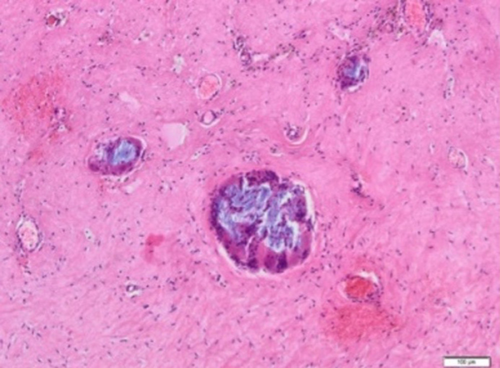 Aquafilling® deposits (blue) are present within the sclerotic connective tissue, with multinucleated giant cells inside (H&E, 100×).
