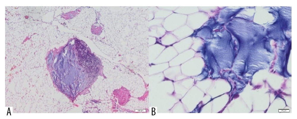 Adipose tissue containing Aquafilling® filler (blue) (A) with extensive inflammatory infiltrate in the area (H&E, 40×) and (B) dislodging cells of the tissue (H&E, 400×).