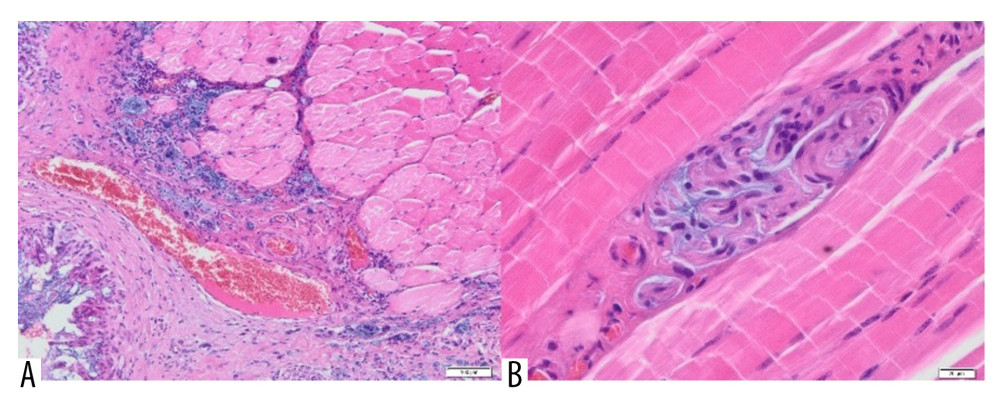 (A) Skeletal muscle with the presence of scar tissue, with a large blood vessel and a profuse inflammatory, infiltrate penetrating the muscle. Visible small foci containing Aquafilling® filler (blue) (H&E, 100×). (B) A small amount of Aquafilling® is visible within the skeletal muscle (blue). Lymphocytes are present within the filler (H&E, 400×).