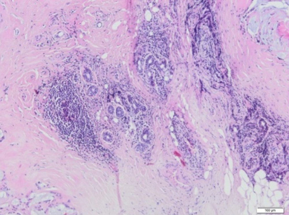 A fragment of the mammary gland with significant fibrosis and the presence of lymphocytic infiltrates (H&E, 100×).