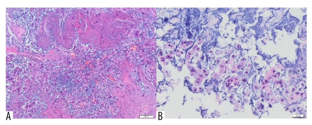 (A) Inflammatory granulation tissue with necrotic foci and numerous small foci of Aquafilling® deposits (blue) (H&E, 400×). (B) Visible basophilic Aquafilling® content (blue) containing numerous macrophages within (H&E, 400×).