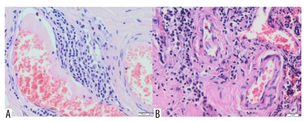 (A) Blood vessels are visible within the connective tissue, with lymphocyte infiltrations in the vicinity of one (H&E, 40×). (B) Vessels with thickened walls, surrounded by lymphocytic infiltration and fibrosis. H&E, 40× magnification.