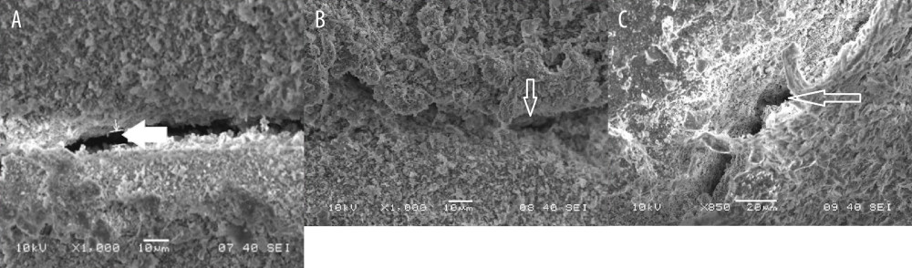 (A) SEM photomicrograph (5000×) showing marginal gap width at the apical third of the canal in a sample with SCT obturation. (B) SEM photomicrograph (5000×) showing marginal gap width at the middle third of the canal in a sample with SCT obturation. (C) SEM photomicrograph (5000×) showing marginal gap width at the coronal third of the canal in a sample with SCT obturation. Figure created using MS Paint, version 11.2301.22.0, Windows 11 Pro, (Microsoft Corporation).