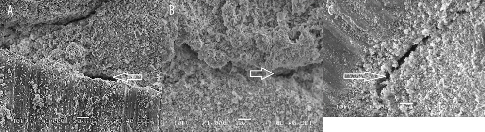 (A) SEM photomicrograph (5000×) showing marginal gap width at the apical third of the canal in a sample with cold lateral compaction technique obturation (CLCT). (B) SEM photomicrograph (5000×) showing marginal gap width at the middle third of the canal in a sample with cold lateral compaction technique obturation (CLCT). (C) SEM photomicrograph (5000×) showing marginal gap width at the coronal third of the canal in a sample with cold lateral compaction technique obturation (CLCT). Figure created using MS Paint, version 11.2301.22.0, Windows 11 Pro, (Microsoft Corporation).