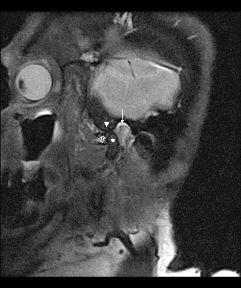 0MRI oblique sagittal image of left temporomandibular joint obtained with the mouth opened in a patient with temporomandibular joint dysfunction. A moderate-sized joint effusion is located in the superior joint compartment (arrow). The mandibular condyle (arrowhead), which is normally located within the glenoid fossa (asterix) of the temporal bone, is displaced anteriorly. The articular disc (thick arrow) is displaced anteriorly.