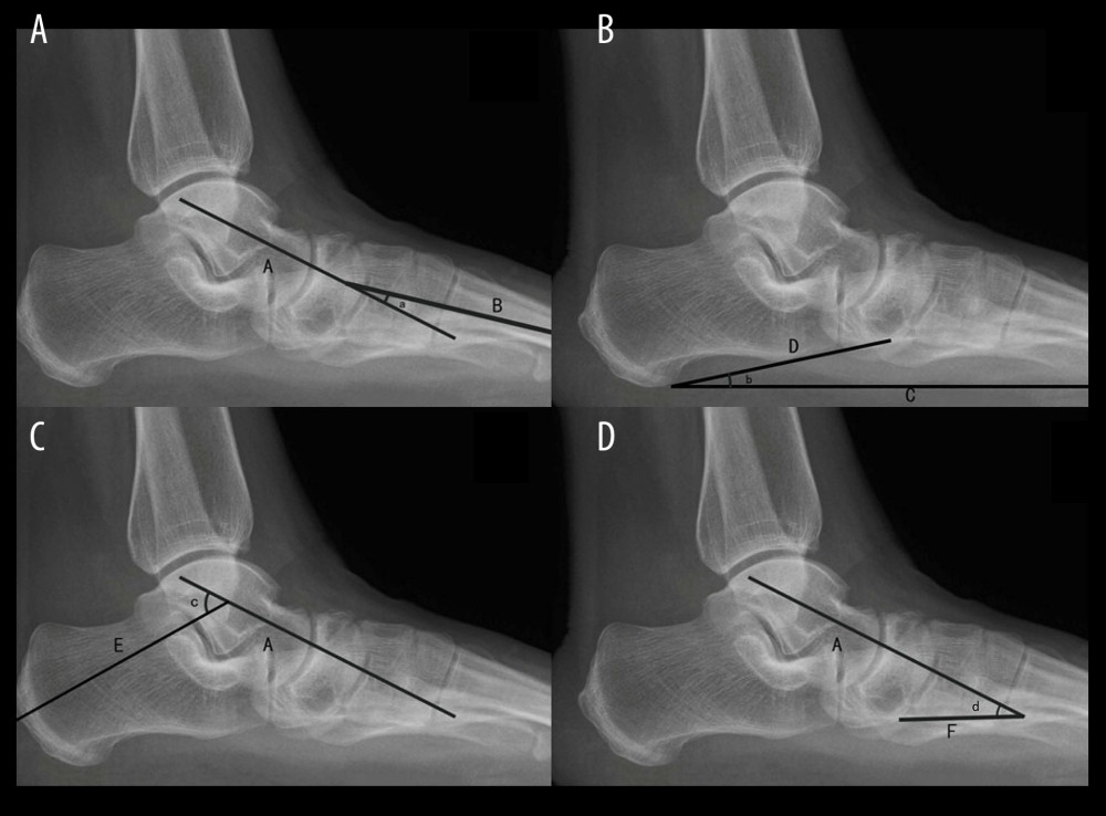 (A–D) Lateral X-rays of the ankles: A) the axis of the talus; B) the axis of the first metatarsal; C, D, E, F) the sagittal axis of the participants’ body; a) the talo-first metatarsal; b) the calcaneal pitch angle; c) the talocalcaneal angle; d) the talar tilt angle.