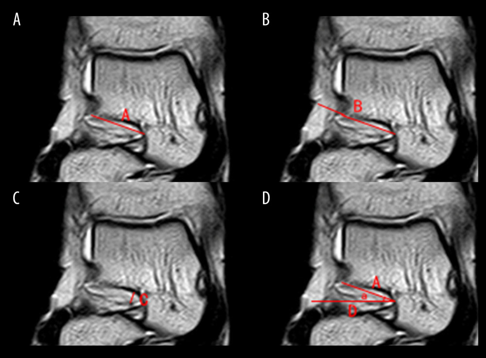 (A–D) Horizontal plane in MRI. A) The length of the sinus tarsi; B) the length of the subtalar implant; C) the diameter of the sinus tarsi; D) the coronal axis; a) the angle of the sinus tarsi in the coronal axis. MRI – magnetic resonance imaging.