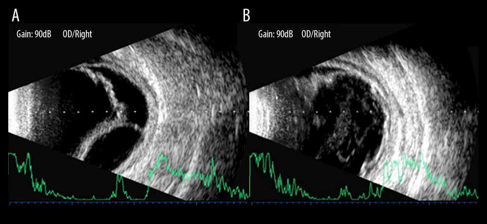 B-ultrasonography showed the changes of pneumatic retinopexy before and after treatment in patients with combined retinal and choroidal detachment. (A) Shows retinal and choroid detachment, and (B) shows the retinal and choroid detachment after PR treatment.