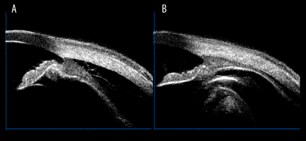 Ultrasound bio-microscopy examination showed the change of pneumatic retinopexy before and after treatment in patients with combined retinal and choroidal detachment. (A) Shows a marked detachment of the ciliary body from the sclera, and (B) shows a basic reduction of the detached ciliary body after pneumatic retinopexy treatment.