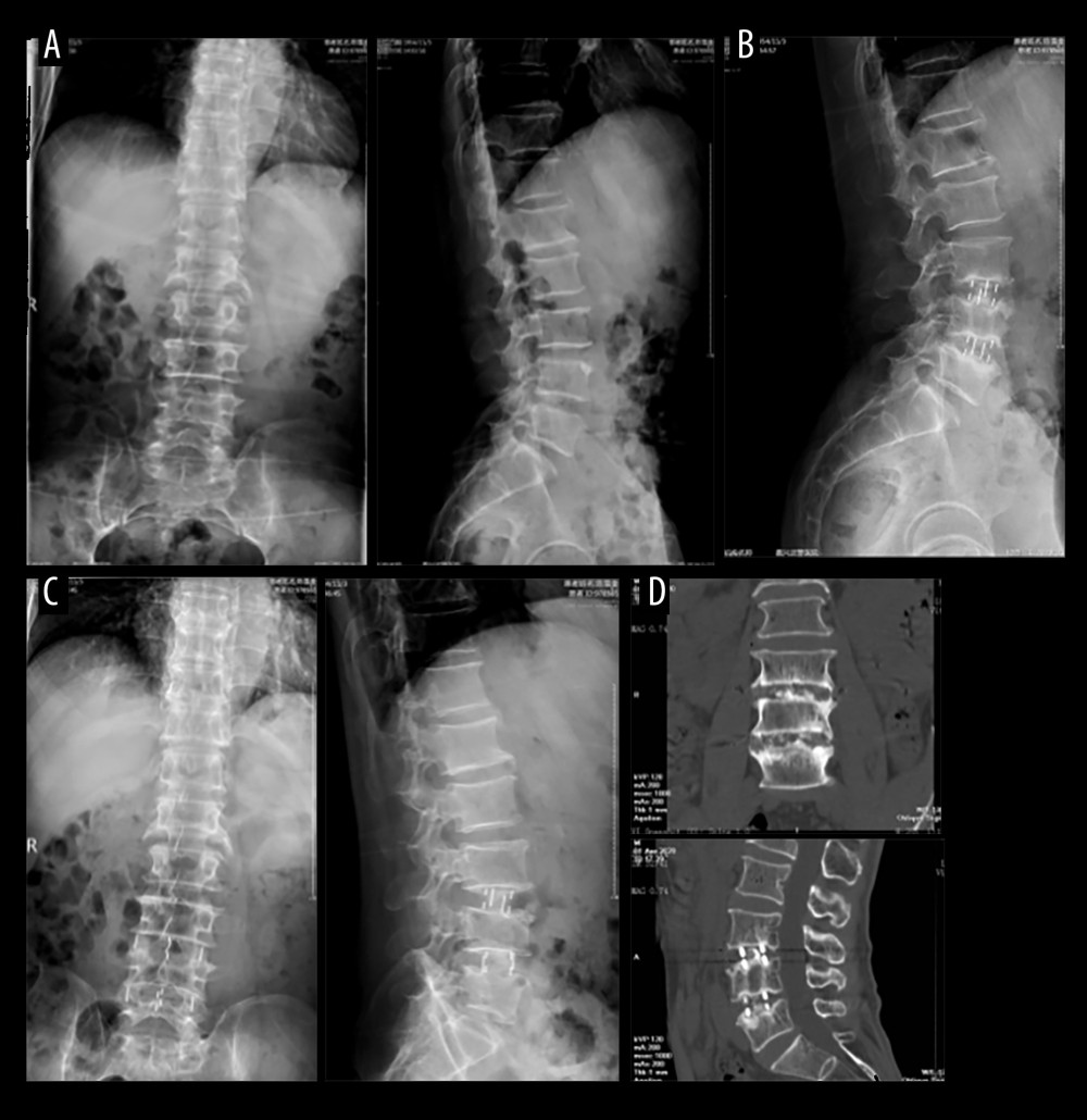 A 63-year-old male patient with diagnosis(A) Lumbar 3/4, lumbar 4/5 intervertebral disc degeneration. (B) Translateral oblique lateral lumbar 3/4, lumbar 4/5 interbody fusion. (C) Postoperative lumbar spine X-ray front and side radiographs. (D) Postoperative 26 months; the lumbar CT plain scan and coronal and sagittal reconstruction.