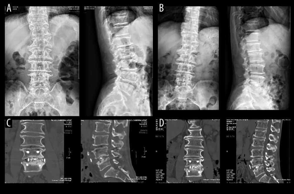 A 63-year-old male patient with diagnosis(A) The X-ray front and side view of the lumbar spine before operation. (B) At 1 month after the operation, the lumbar spine X-ray front and side radiographs. (C) Lumbar spine CT scan and coronary scan 1 year after reconstruction of the facial and sagittal planes. (D) CT plain scan of the lumbar spine 2.5 years after surgery and reconstruction of the coronal and sagittal planes.