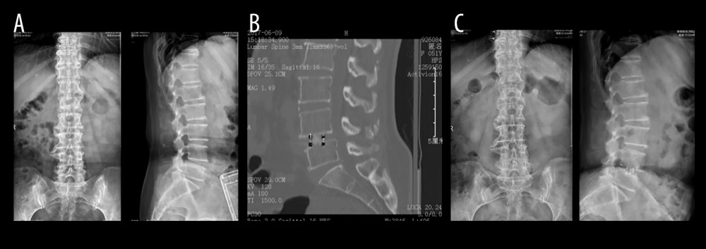 A 51-year-old female patient with diagnosis(A) Preoperative lumbar spine X-ray front and lateral view. (B) Postoperative lumbar CT plain scan and sagittal reconstruction. (C) At 2 years and 10 months after surgery, lumbar spine X-ray front and side view.