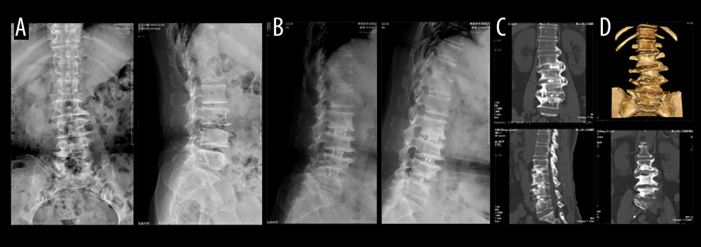 A 61-year-old female patient with diagnosis(A) Preoperative lumbar X-ray positive and lateral radiographs. (B) At 2 years and 8 months after surgery, lumbar spine X-ray hyperflexion and extension lateral view. (C) Two years after surgery, lumbar CT plain scan and reconstruction of the coronal and sagittal planes. (D) Lumbar CT plain scan at 2 years and 8 months after surgery.