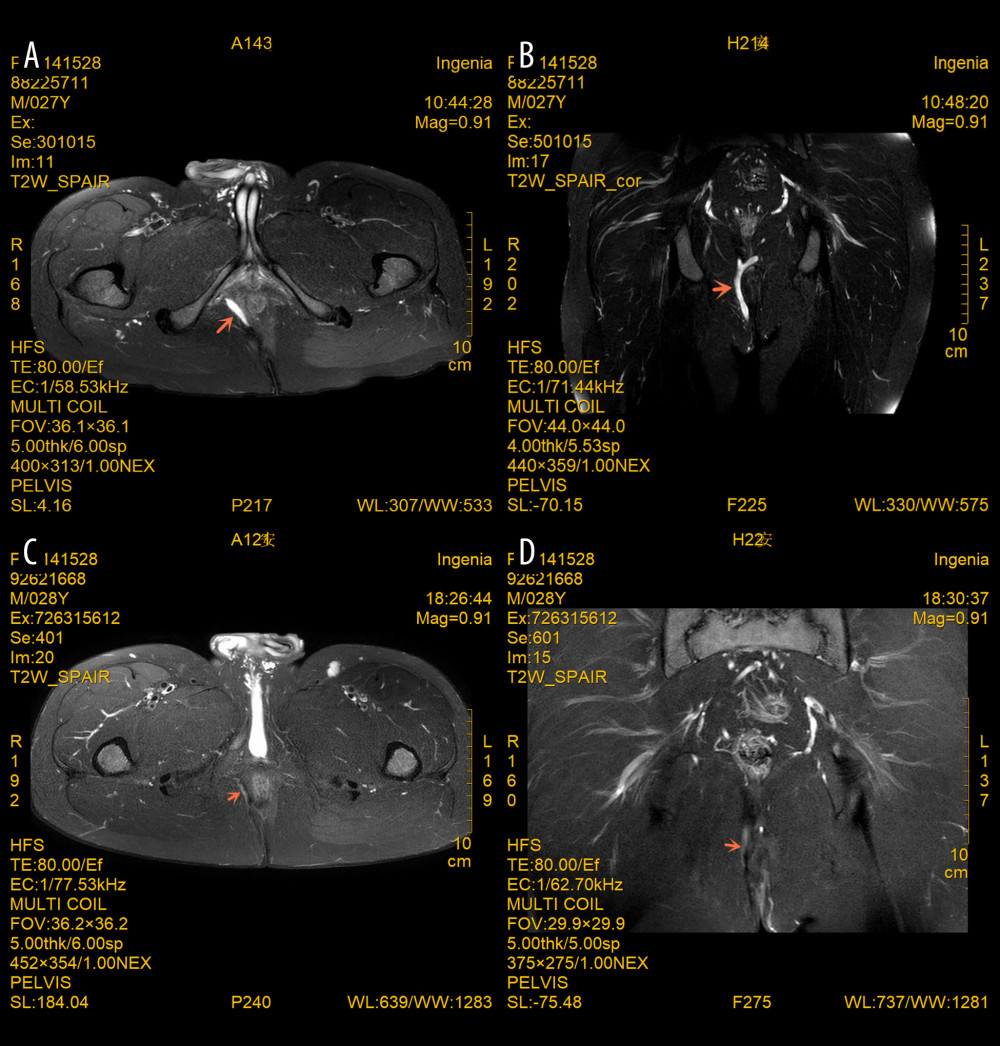 (A–D) MRI images of a perianal fistula in a young male patient with PFCD before and 6 months after IOAC. Note that the inflammatory component (T2 hyperintensity and collections) markedly improved and the fistula track disappeared. The oblique coronal plane and oblique transverse plane are parallel and perpendicular to the longitudinal axis of the anal canal, respectively. The orange arrows indicate changes in the site of the lesion.