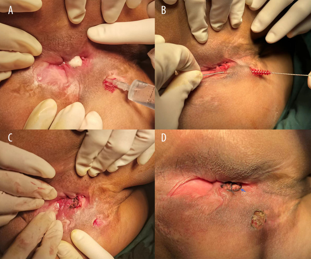 IOAC surgery was performed on a young male PFCD patient with repeated perianal surgery. (A) Confirmation of the internal orifice of the fistula. (B) Clean the epithelium lining the fistula. (C) The mucosa 1 cm around the internal orifice was removed. (D) The muscular layer was closed by the anal fistula clip (blue arrowheads).