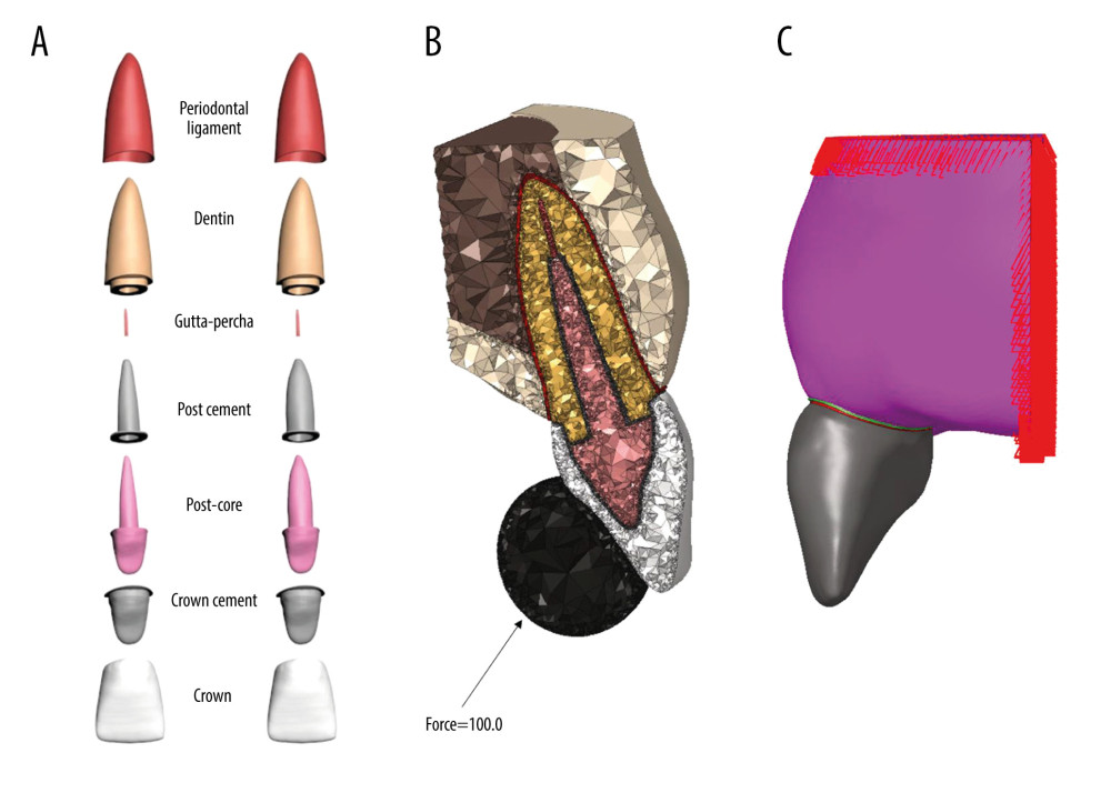 Analysis models with 2.5-mm and 3.5-mm diameters. Periodontal ligament, dentin, gutta-percha, post cement, post-core, crown cement, crown (A). Loading scenario (B). Boundary conditions (C). (Photoshop CS2, version 9.0, Adobe Systems).