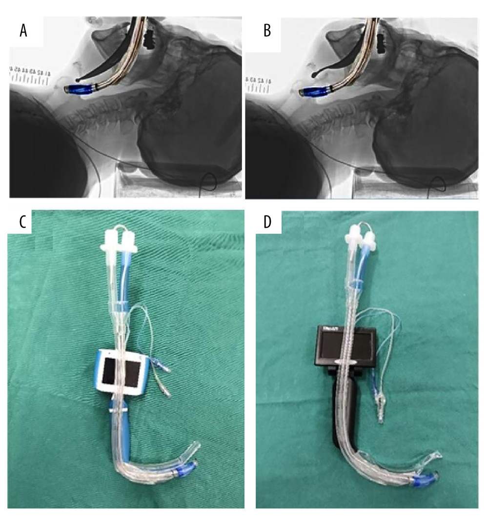 Two types of videolaryngoscopes and the left-sided double-lumen tube (LDLT). (A) Superimposing the image of the hockey stick-shaped LDLT on the radiograph laryngoscopy image with the Macintosh laryngoscope. (B) Superimposing the image of the hockey stick-shaped LDLT on the radiograph laryngoscopy image with the direct Nishikawa blade. (C) The UE videolaryngoscope and hockey stick-shaped LDLT. (D) The MedAn videolaryngoscope with the Nishikawa blade and LDLT.
