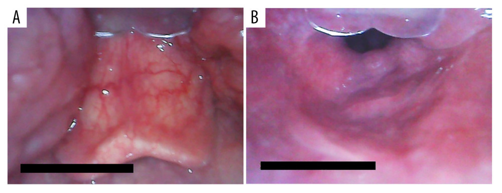 Glottic exposure with the MedAn videolaryngoscope. (A) The long U-shaped epiglottis observed with the MedAn videolaryngoscope by indirectly lifting the epiglottis. (B) The laryngeal view observed with the MedAn videolaryngoscope by directly lifting the epiglottis.