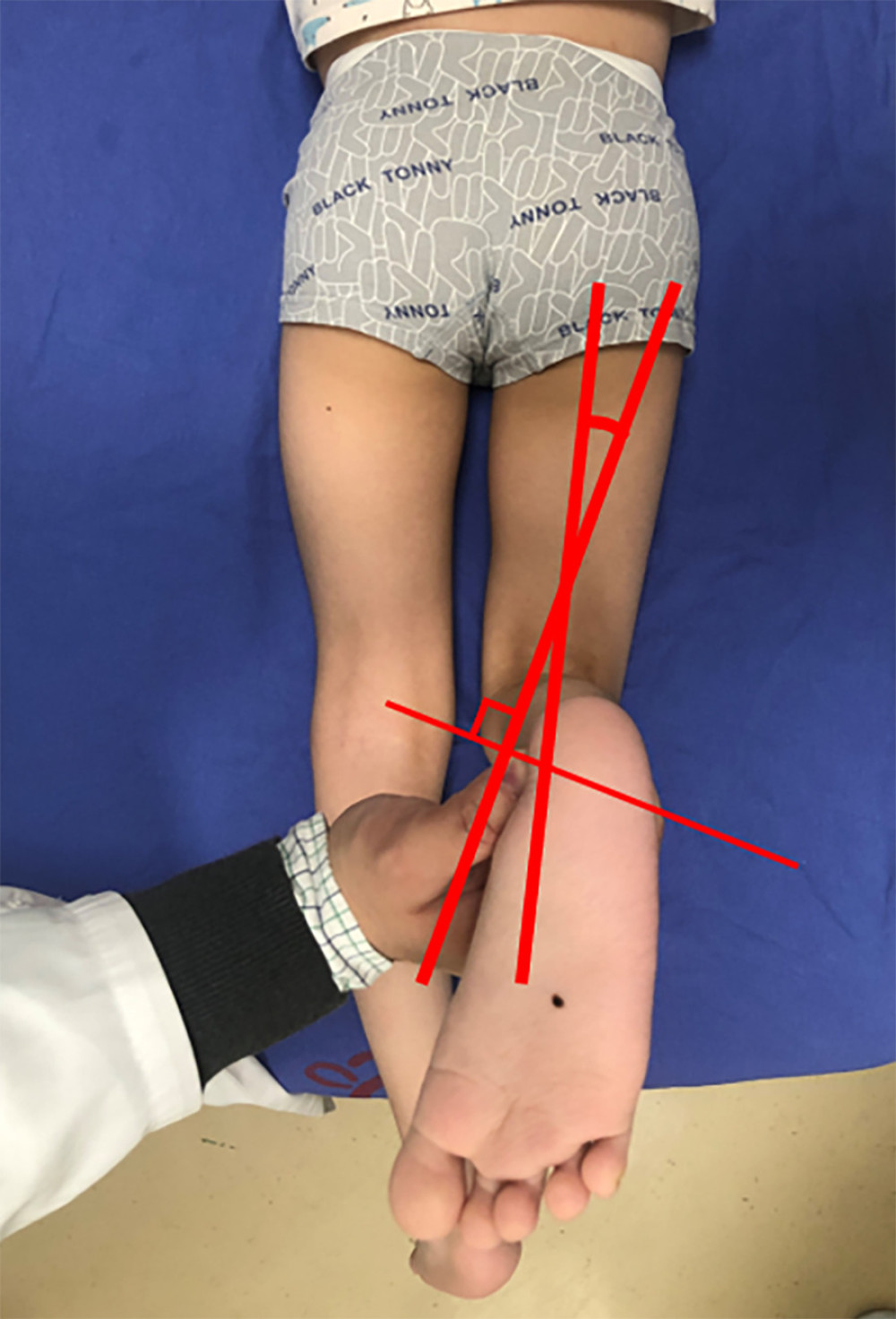 Clinical measurement of the tibial torsion by using the transmalleolar axis (TMA).