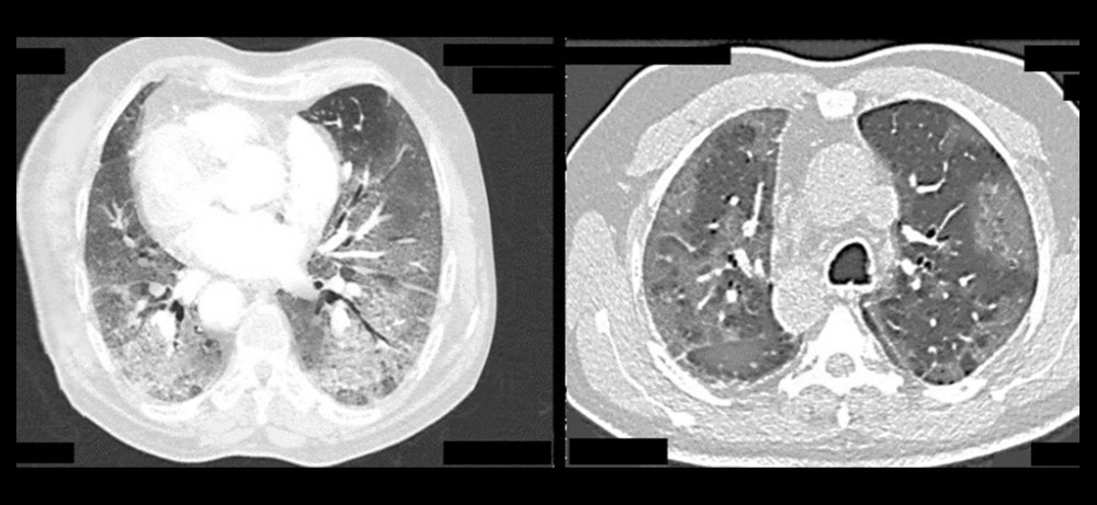 Axial HRCT images showing severe changes in COVID-19 pneumonia.
