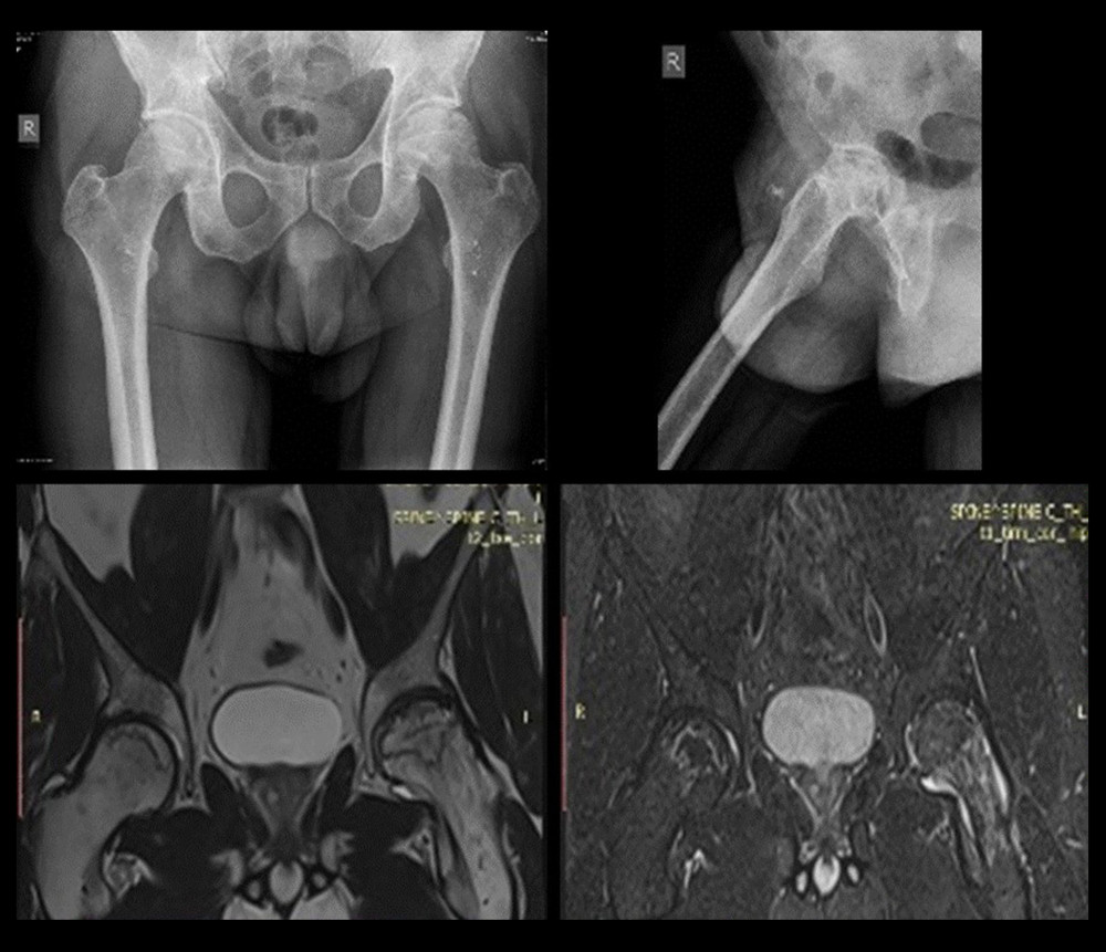 Sample anteroposterior (AP) and lateral radiographs (top), and MRI images (bottom) of femoral head AVN.