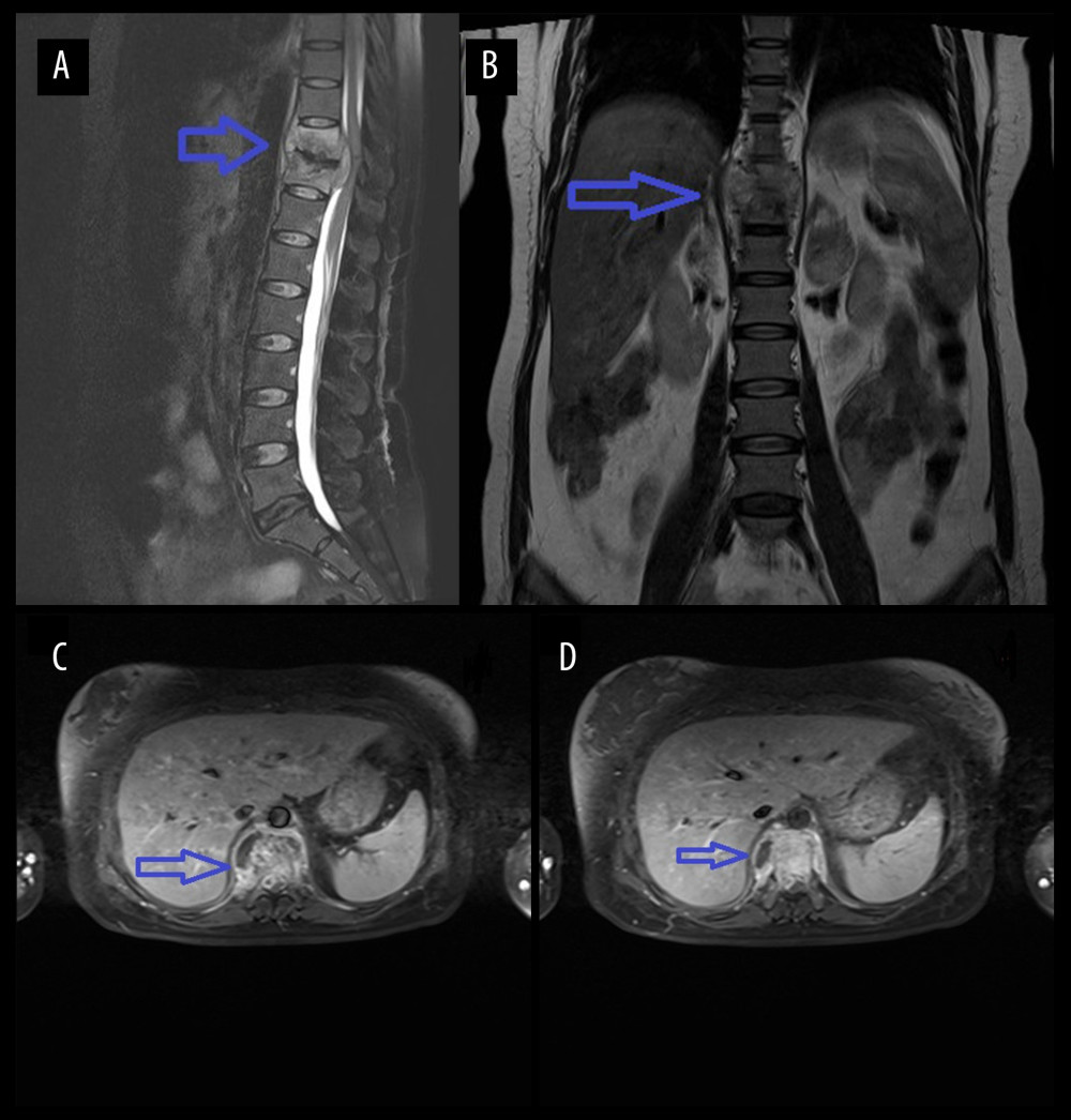 Figure A is the sagittal view of the preoperative thoracic spine MRI. Figure B is the coronal view. Figures C and D are the transverse views of the diseased vertebral body, showing high-signal intensity of the 10th and 11th thoracic vertebrae on T2WI, corresponding to the formation of abscesses in the spinal canal, compressing the spinal cord.