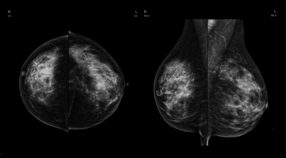 FFDM (full-filled digital mammography) of a patient with dense, glandular breast type. No evident lesion is seen.