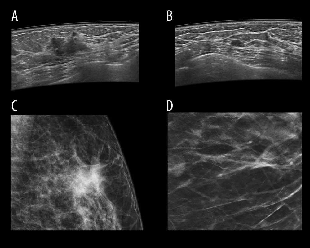 Image of focal lesion’s margin on ABUS and FFDM depending on its type. Figure A shows ABUS image and C shows FFDM image of the same malignant lesion with ill-defined margin. Figure B shows ABUS image of benign lesion with well-defined margin. Figure B shows ABUS image and Figure D shows FFDM image of the same benign lesion with well-defined margin.