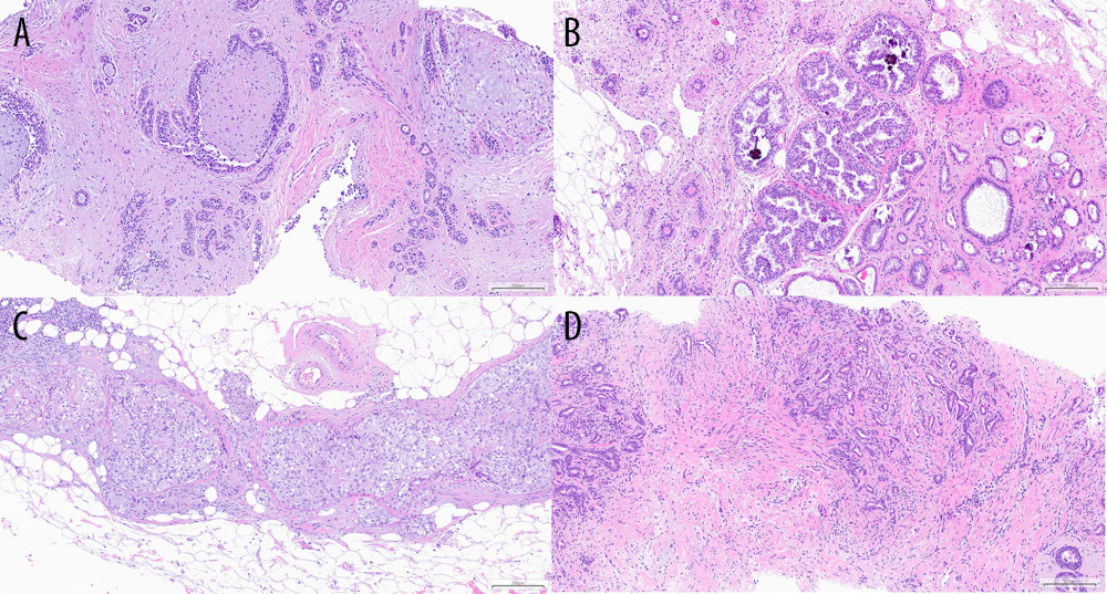 Examples of histopathology specimens at 10× magnification. Figure A shows fibroadenoma. Figure B shows ADH. Figure C shows DCIS G2. Figure D shows NST cancer G1.